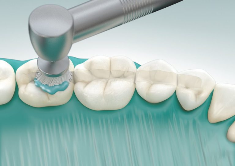 Coronal Polish Course | KAIROSCC