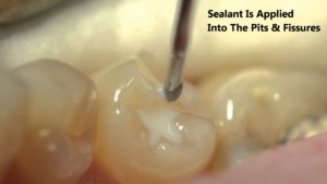 Pit and Fissure Sealant